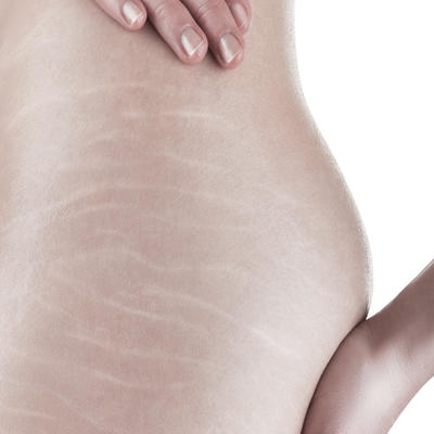 Are stretchmarks on thighs or butt sexy?