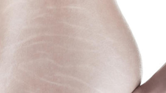 Are stretchmarks on thighs or butt sexy?