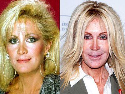 Do celebrities go too far with plastic surgery?