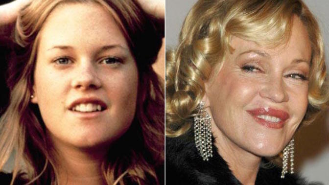 Do celebrities go too far with plastic surgery?