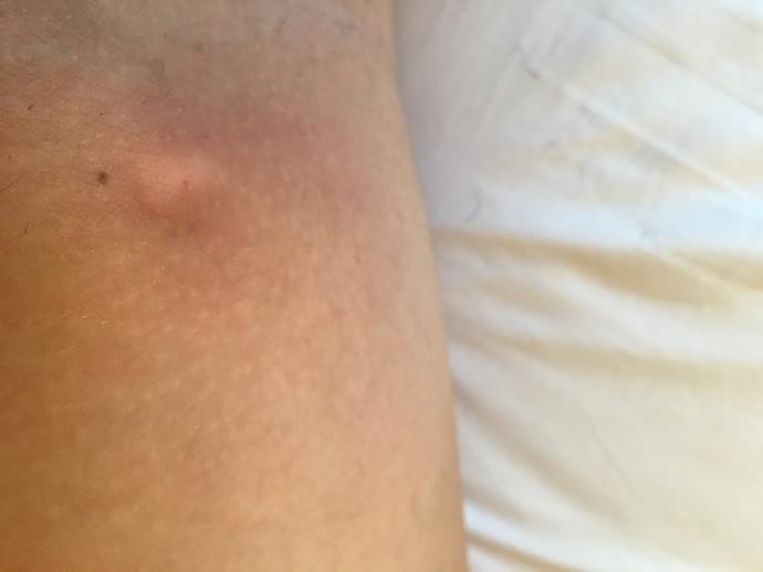 What is this mass on my upper inner thigh?