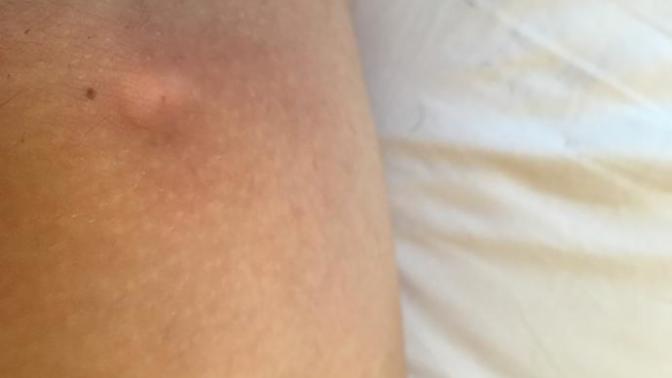 What is this mass on my upper inner thigh?