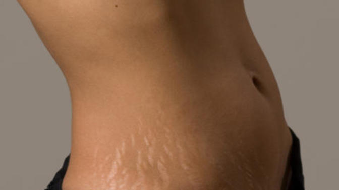 Are guys fine with stretch marks?