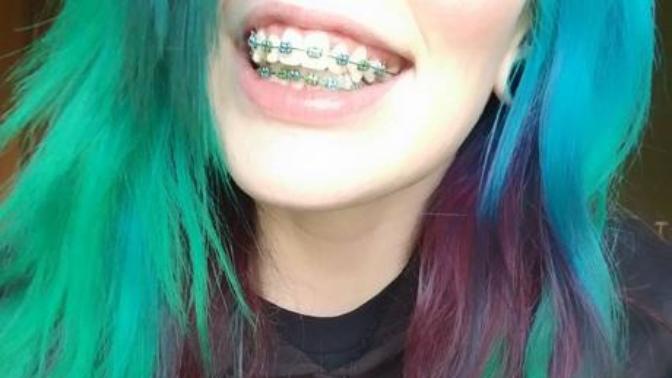 Girls, I got my braces colours changed to match my hair, what do you think?