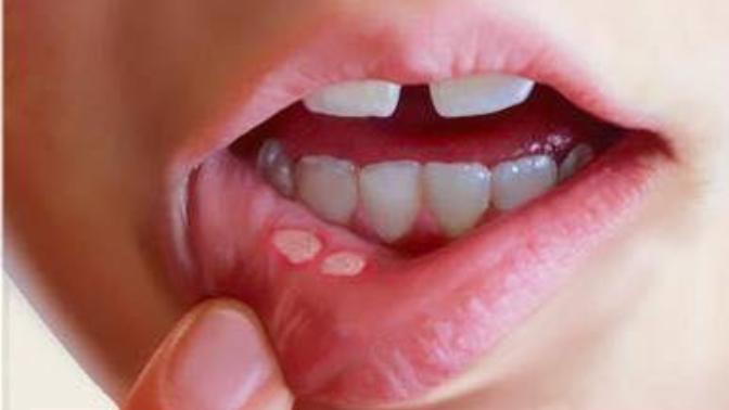 Any home remedies for canker sore's?