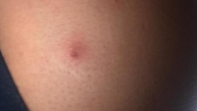 What are these red bumps on my butt near my crease?