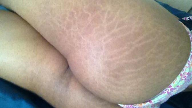 Are severe stretch marks on a girl's bum a turn off?