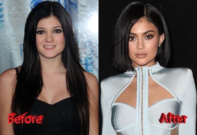 Has Kylie Jenner honestly gotten more attractive with the cosmetic work she had done?