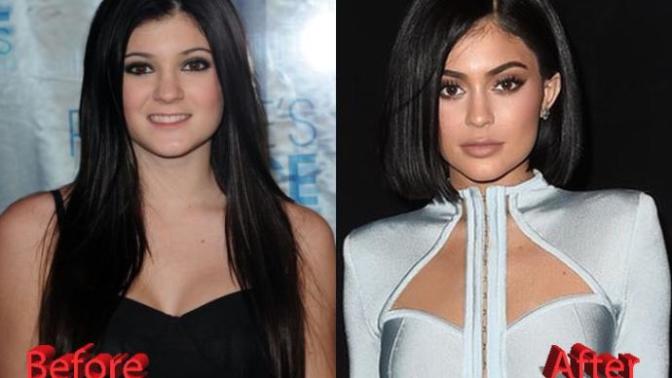 Has Kylie Jenner honestly gotten more attractive with the cosmetic work she had done?