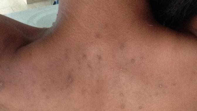 Is a girl with really bad back acne scars a deal breaker?