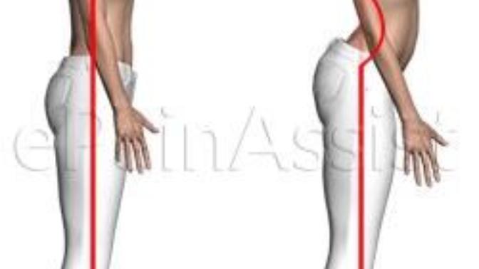 Can you tell a difference between a girl with a big butt or just a back problem?