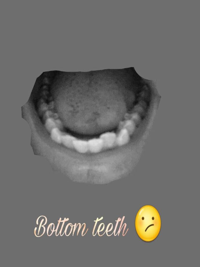 Would you say I need braces?