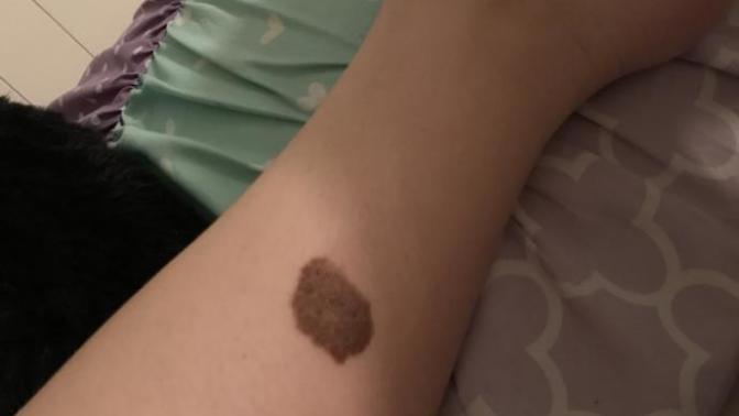 Does a birthmark bother you?