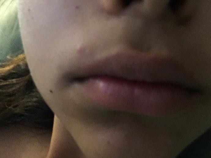 Would you kiss a girl if she had a pimple on her face above her lip?
