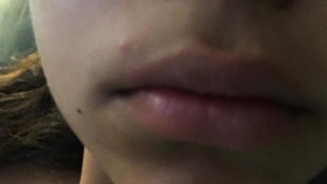 Would you kiss a girl if she had a pimple on her face above her lip?