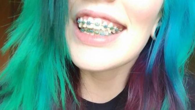 Girls, Are my braces off putting/unsightly?