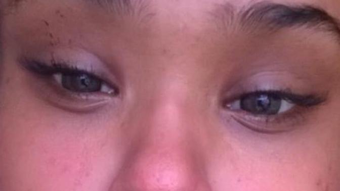 My small sister got sunburn and she's black is this normal for black people?