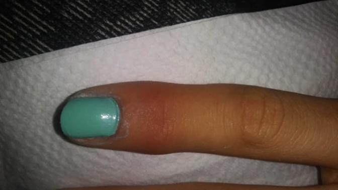 Should I go to the doctor I'm not sure if my finger is still swollen or I sprained it (pics)?