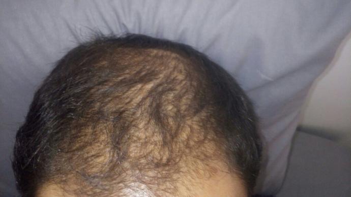 Should I go for hair surgery??
