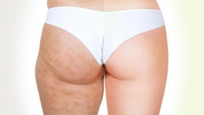Guys, beautiful girls with "lots" of cellulite - can you over look it?