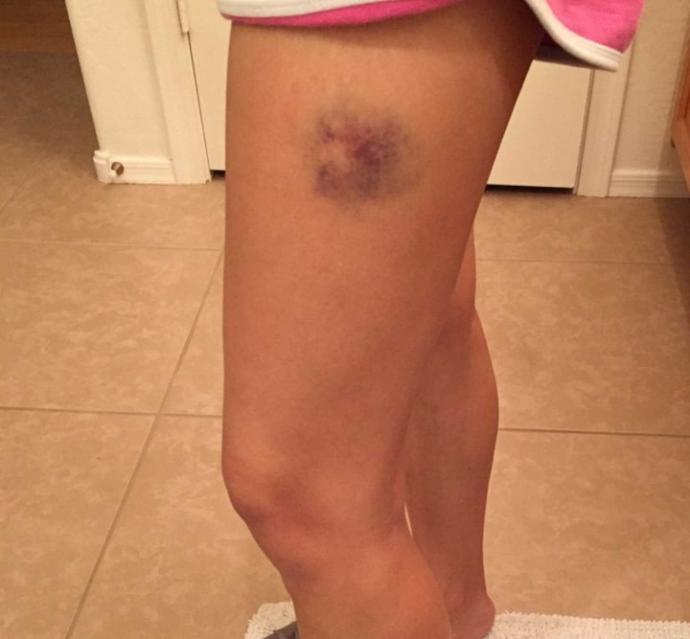 Girl down! ASAP hacks for paintball bruises.?