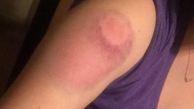 Girl down! ASAP hacks for paintball bruises?