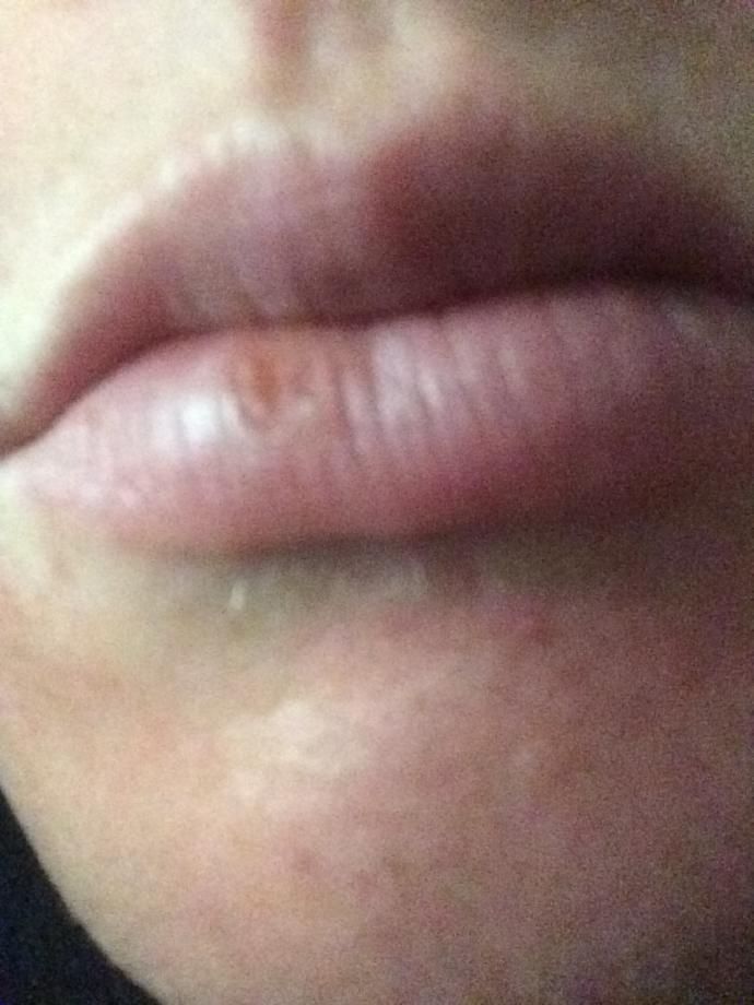 Cracked lips or cold sore?