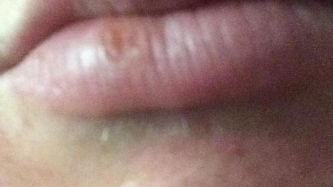 Cracked lips or cold sore?