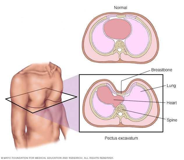 Girls, how weirded out do you feel about pectus excavatum??