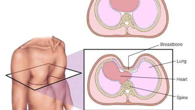 Girls, how weirded out do you feel about pectus excavatum?