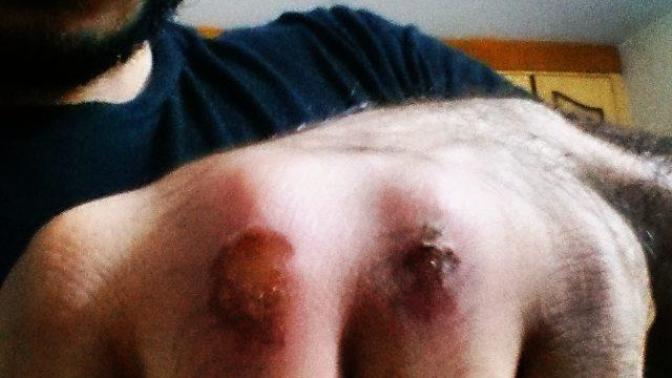 Have you ever punched on a hard punching bag so long enough that your knuckles start to bleed? and what you did for a quick recovery?