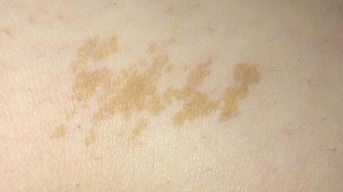What does my birthmark look like?