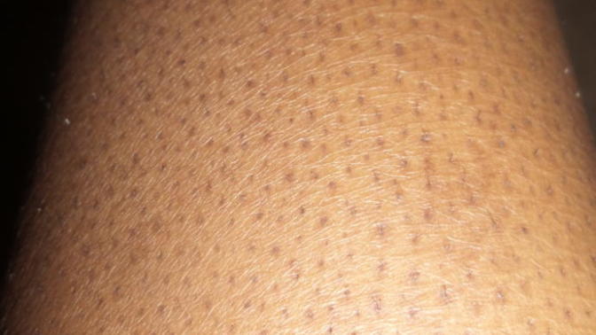 Guys, does Keratosis Pilaris (bumps on leg) make you get turned off by a girl?