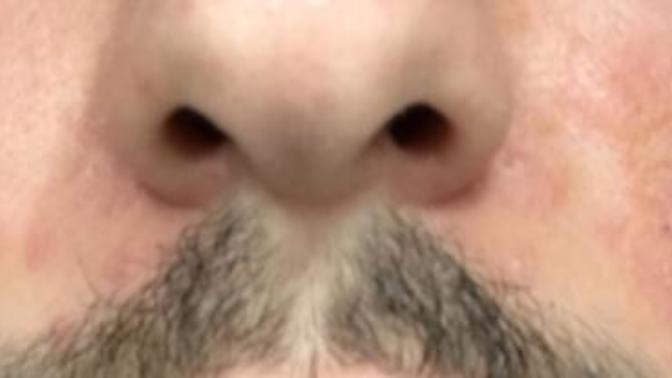 What type of face skin problem is this? pics?