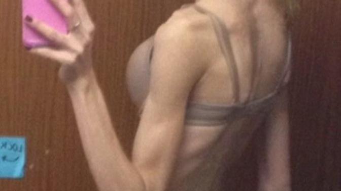 Should asking a happy-go-lucky question where you post your anorexic body on display (just skin and bones) be flagged for suicidal tendencies?