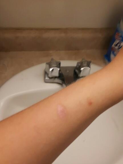 Self Harm Scars Visible... I have my first job interview tommorow with a modelling agency...?