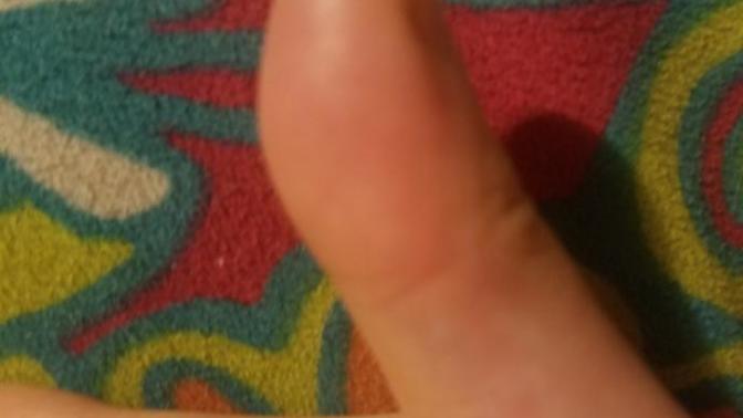 Severe pain in swollen thumb please help me figure out what's wrong?