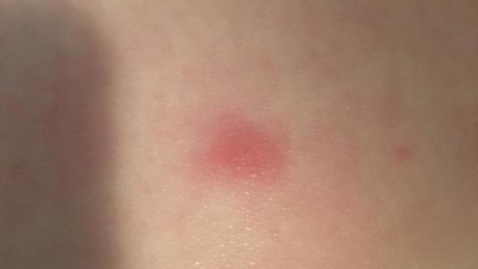What are these itchy bumps on my arm and leg?