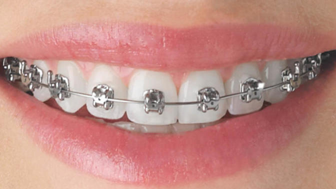 I've questions about braces?