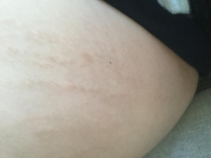 GUYS! Be honest, what do you think about stretch marks?