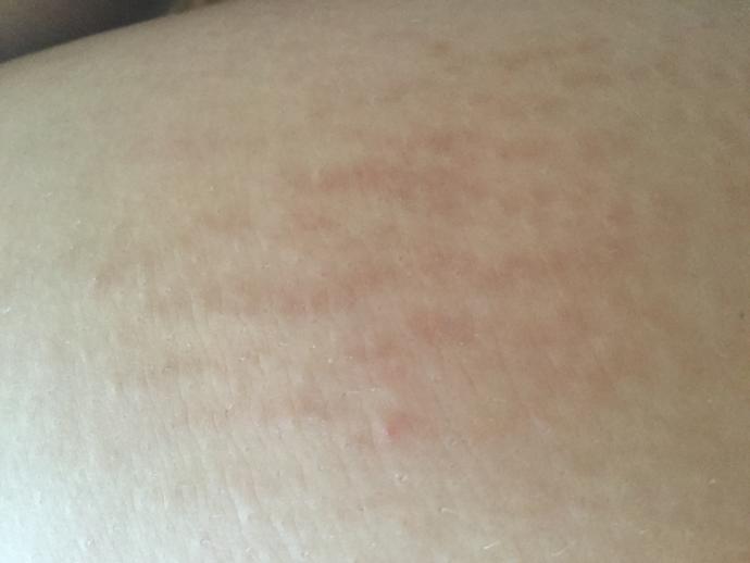 GUYS! Be honest, what do you think about stretch marks?