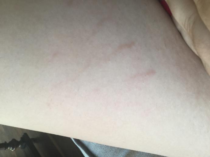GUYS! Be honest, what do you think about stretch marks?