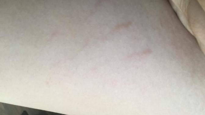 GUYS! Be honest, what do you think about stretch marks?