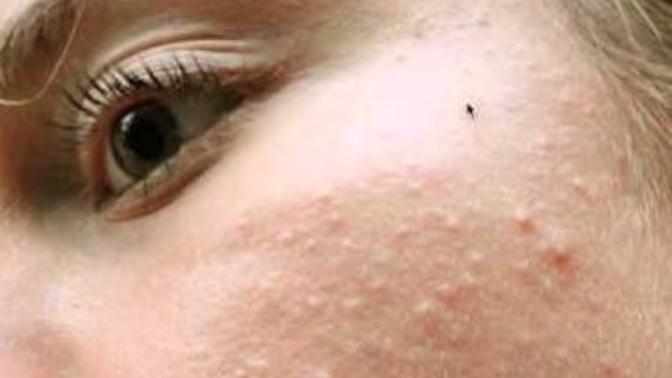 How do I get rid of the little bumps on my face?