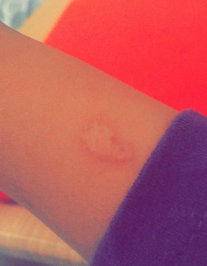 how can i make burns like this disappear from my skin ?