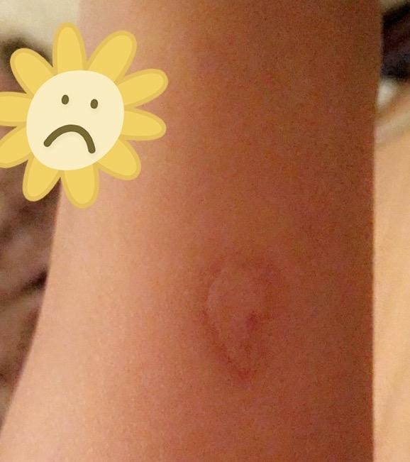 How can I make burns like this disappear from my skin?