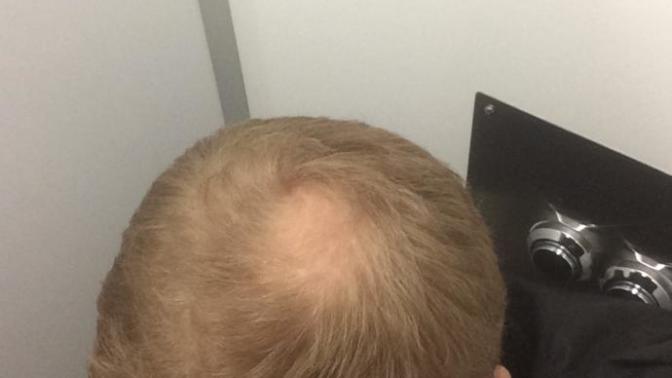 Is my hair thinning?