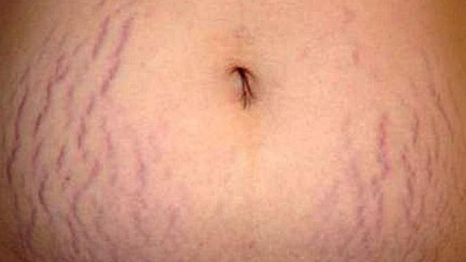 Do you care about stretch marks guys?