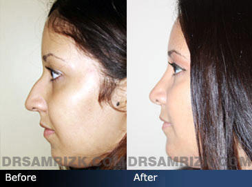 Do guys get turned off by a crooked nose?