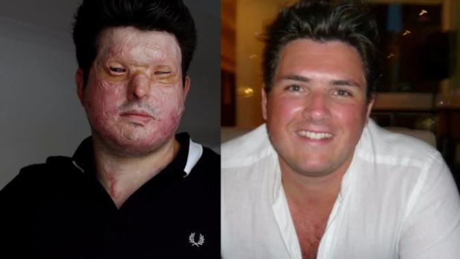 How would you adjust and cope with life if someone threw acid on your face and you became disfigured?